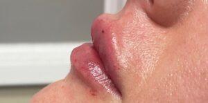 After Image: Lip Filler
