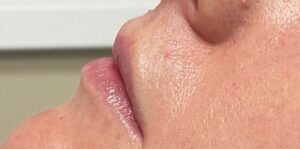 Before Image: Lip Filler
