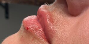 After Image: Lip Filler
