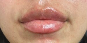 After Image: Lip Filler