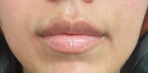 Before Image: Lip Filler