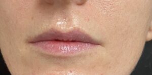 Before Image: Lip Filler